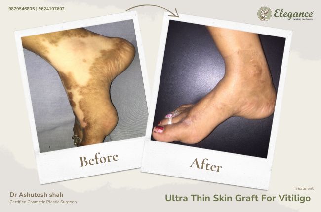 Ultra Thin Skin Graft For Vitiligo (4)