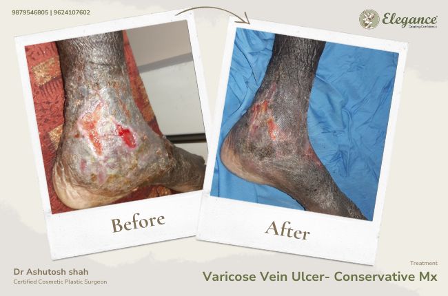 Varicose Vein Ulcer- Conservative Mx (2)