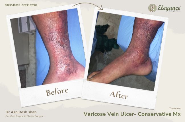 Varicose Vein Ulcer- Conservative Mx
