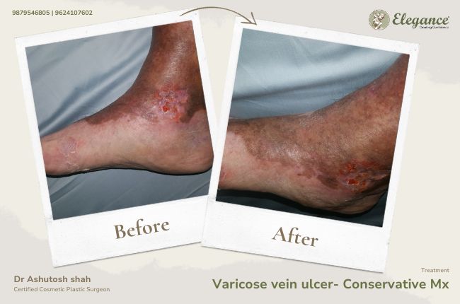 Varicose vein ulcer- Conservative Mx(1)