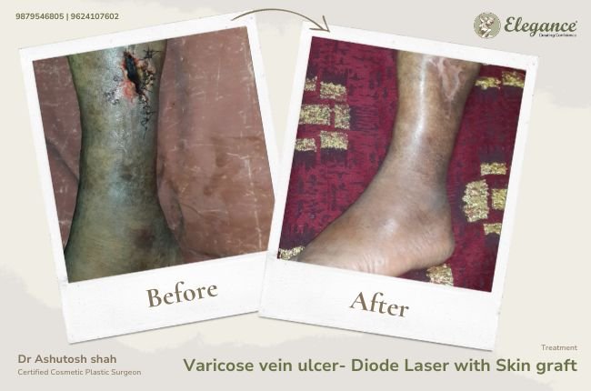 Varicose vein ulcer- Diode Laser with Skin graft (1)