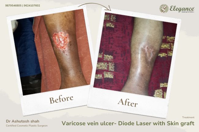 Varicose vein ulcer- Diode Laser with Skin graft (2)