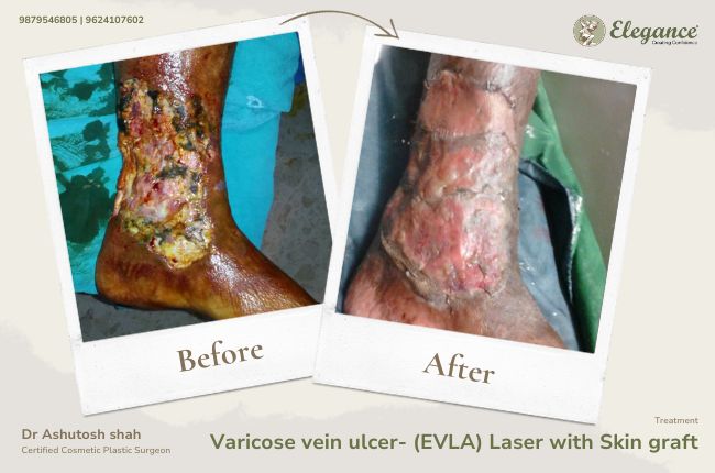 Varicose vein ulcer- (EVLA) Laser with Skin graft (1)