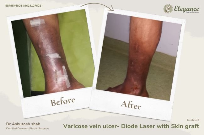 Varicose vein ulcer- Stripping with Skin graft (2)