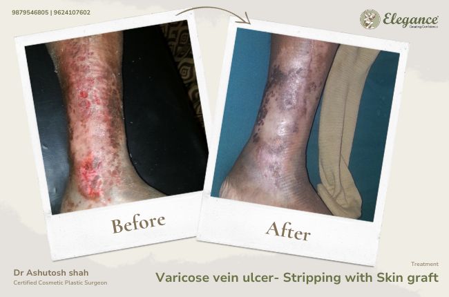 Varicose vein ulcer- Stripping with Skin graft