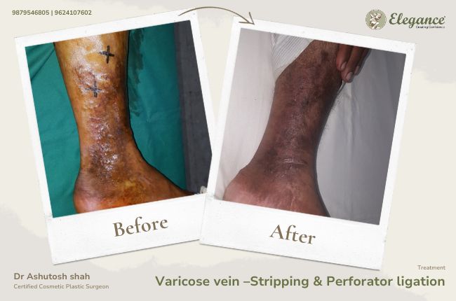 Varicose vein –Stripping & Perforator ligation