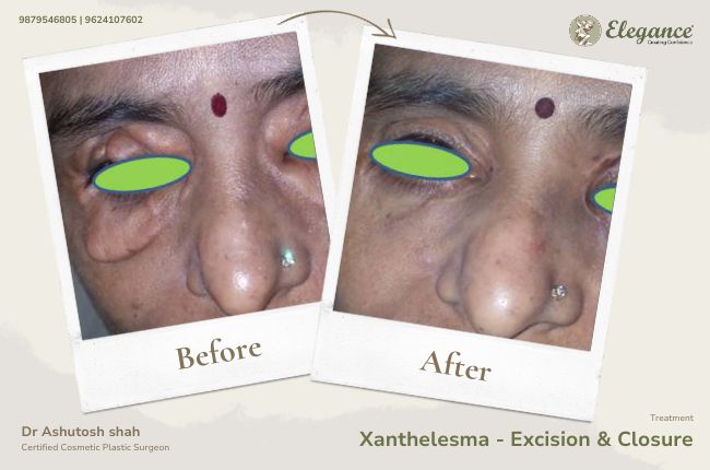 Xanthelesma - Excision & Closure (2)