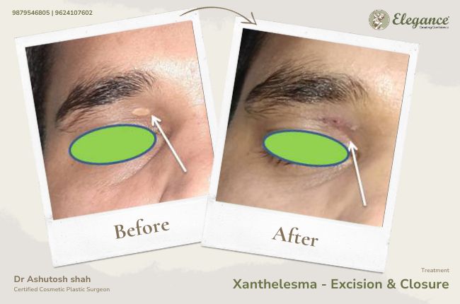 Xanthelesma - Excision & Closure (4)