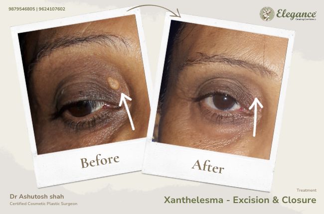 Xanthelesma - Excision & Closure
