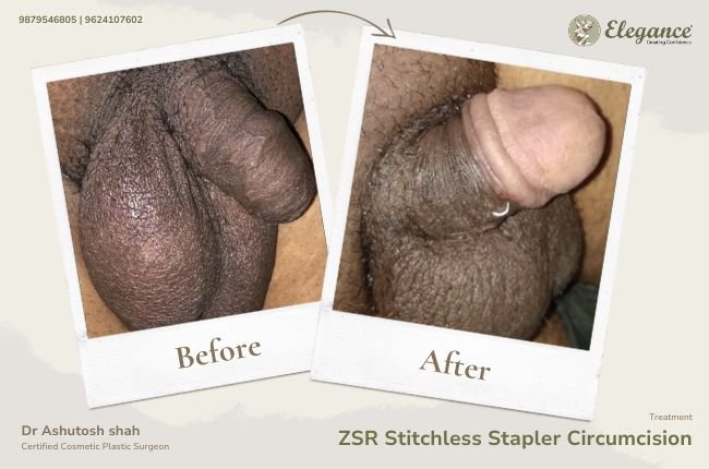 ZSR Stitchless Stapler Circumcision