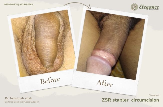 ZSR stapler circumcision