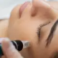 The Benefits of Microneedling Radiofrequency (MNRF)