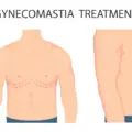 Before and After Gynecomastia Surgery: What Men Should Expect