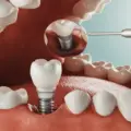 Dental Implants: Procedure, Recovery, and Success Rates