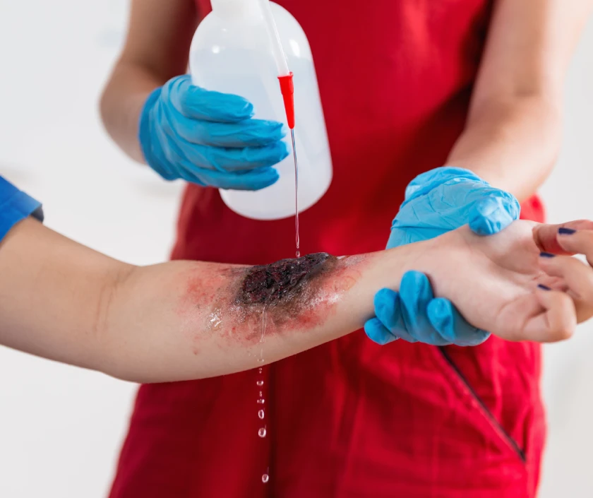 Burns – Reconstructive Plastic Surgery