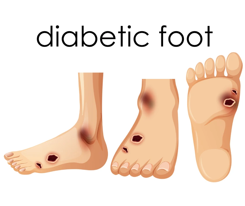 Diabetic Foot and Wound Management