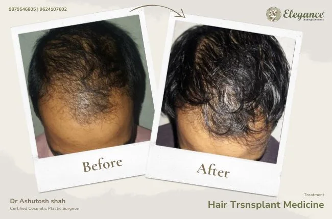 Hair Trsnsplant Medicine