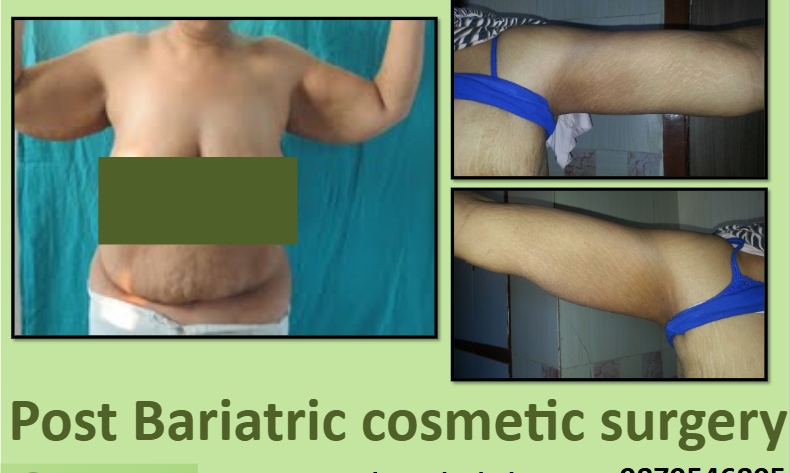 Arm Lift After Weight Loss in Surat