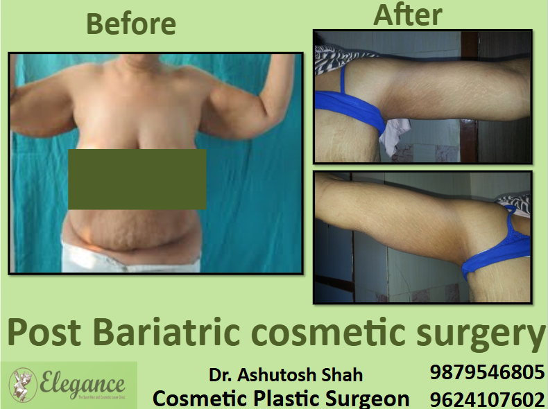 Arm Lift After Weight Loss in Surat