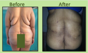 Body Contouring after Weight Loss in Surat