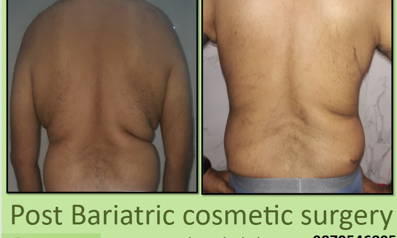 Certified Post Bariatric cosmetic surgery in surat