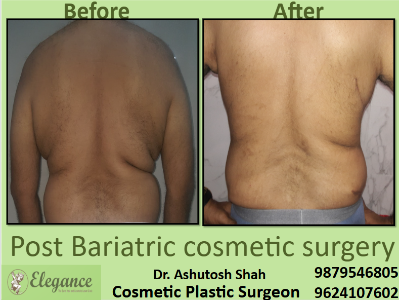 Certified Post Bariatric cosmetic surgery in surat