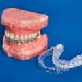 Dental Braces Treatment Options: Invisalign vs Traditional Braces