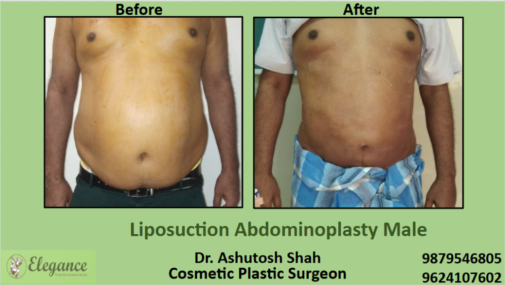 Liposuction Abdominoplasty Male in Surat