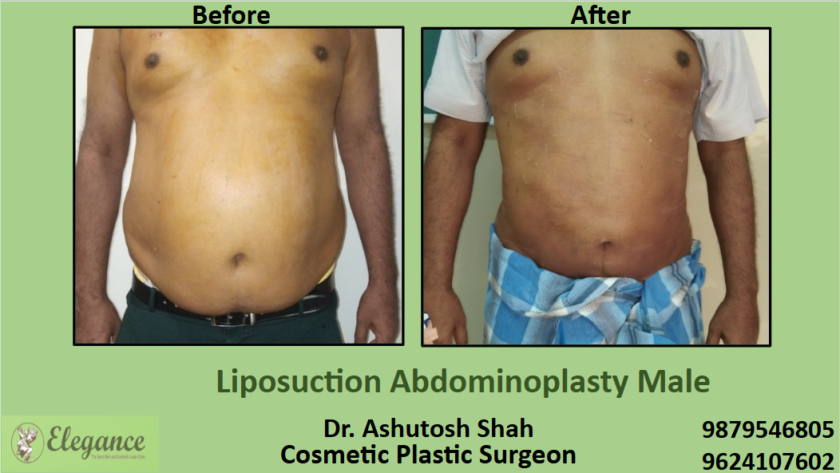 Liposuction Abdominoplasty Male in Surat