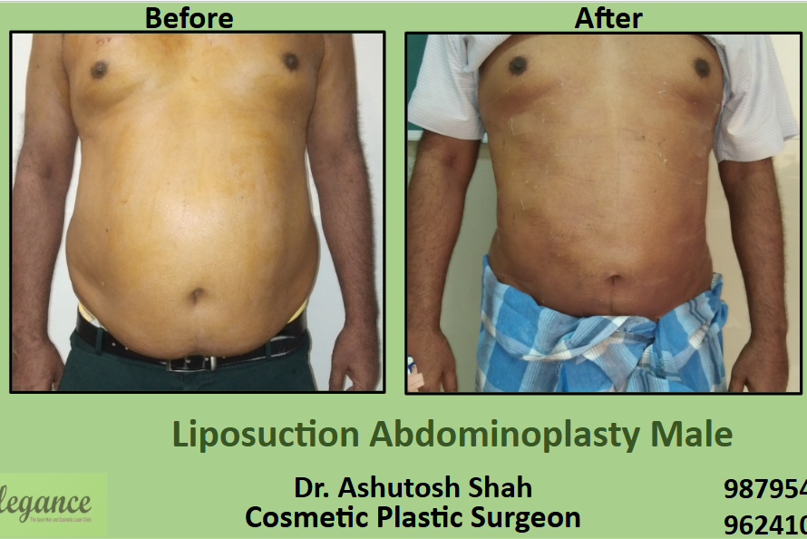 Liposuction Abdominoplasty Male in Surat