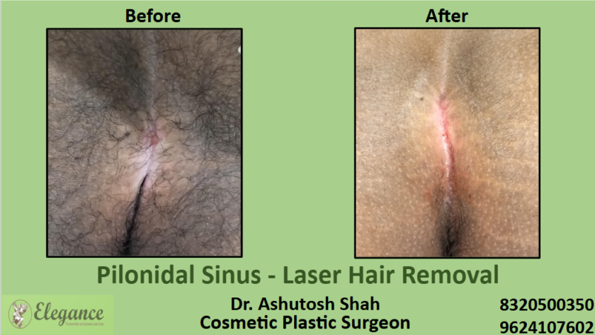 Pilonidal Sinus Laser Hair Removal in Surat