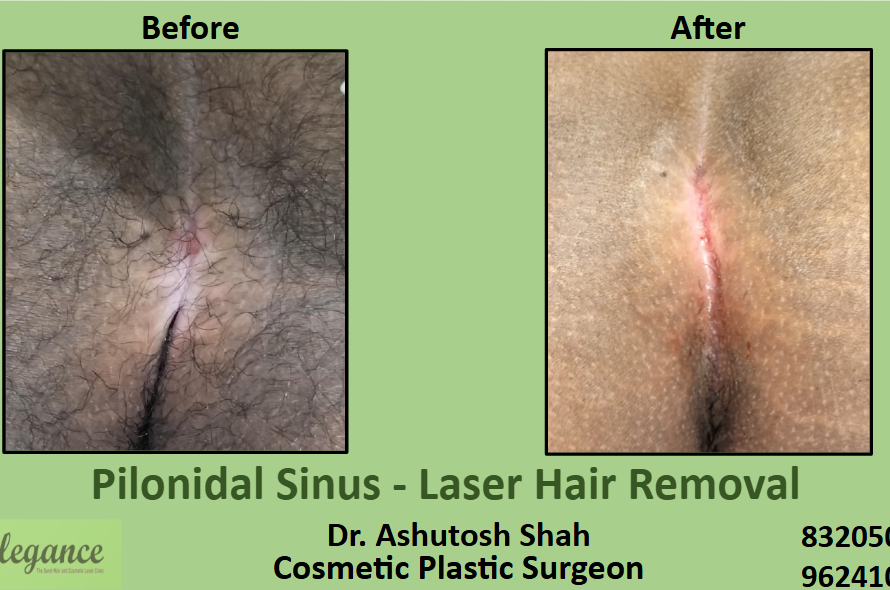 Pilonidal Sinus Laser Hair Removal in Surat