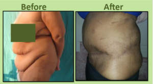 Post Bariatric Cosmetic Surgery in Surat