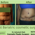 Post Bariatric Cosmetic Surgery in Surat, Restore Your Body Confidence with Expert Care