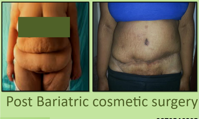 Post Weight Loss Surgery in Surat