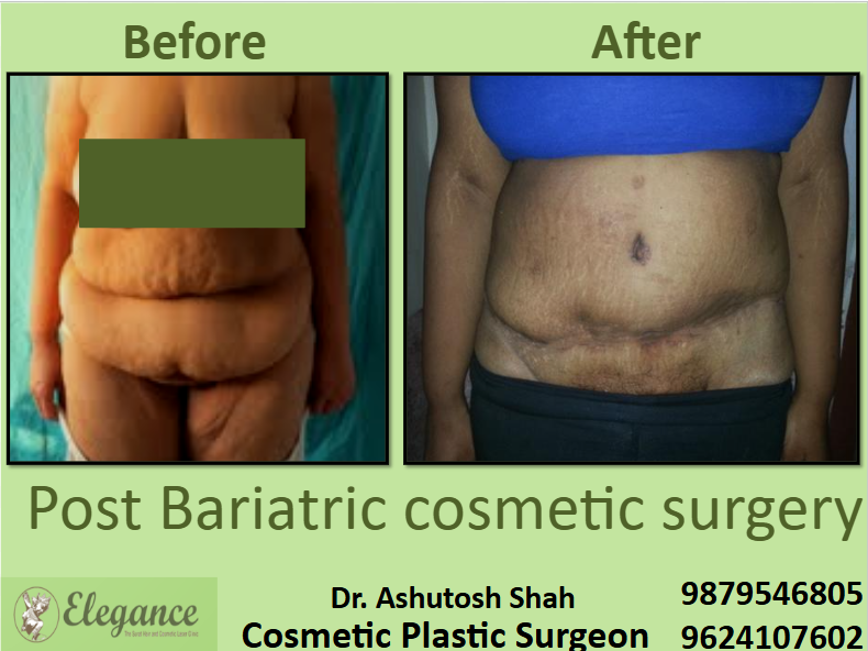Post Weight Loss Surgery in Surat