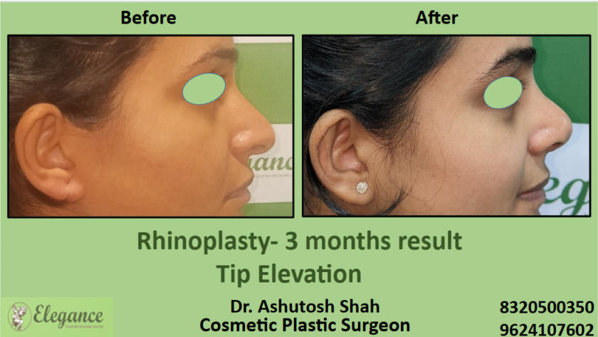 Top tip elevation surgery in Surat