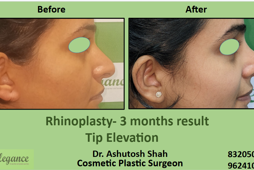 Top tip elevation surgery in Surat