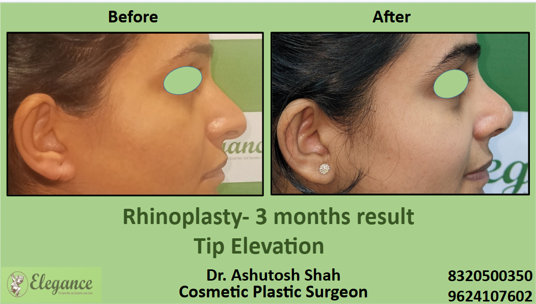 Top tip elevation surgery in Surat