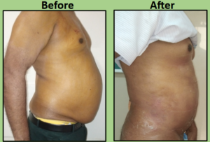 liposuction and tummy tuck for men Surat
