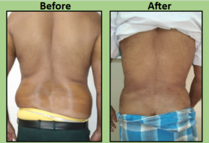 male liposuction abdominoplasty in Surat