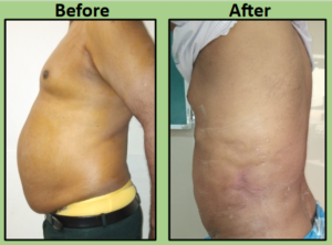 male tummy tuck surgery Surat
