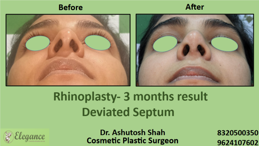 nasal Septum correction surgery in surat