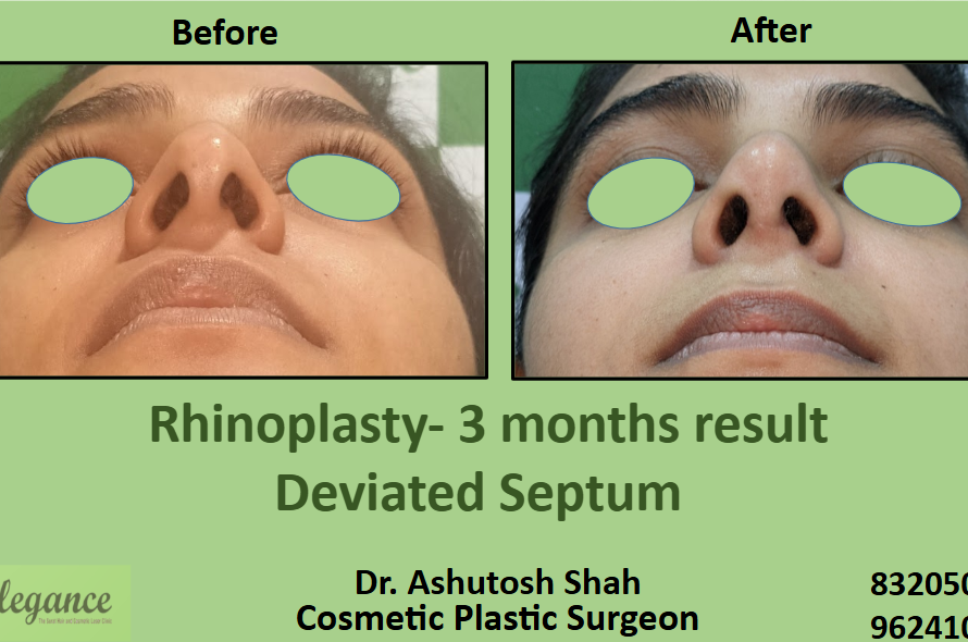 nasal Septum correction surgery in surat