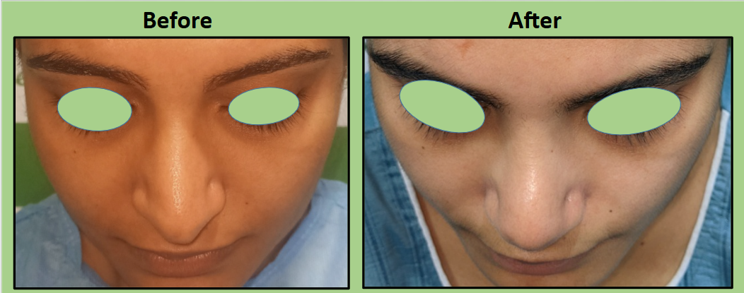 septoplasty and rhinoplasty in Surat