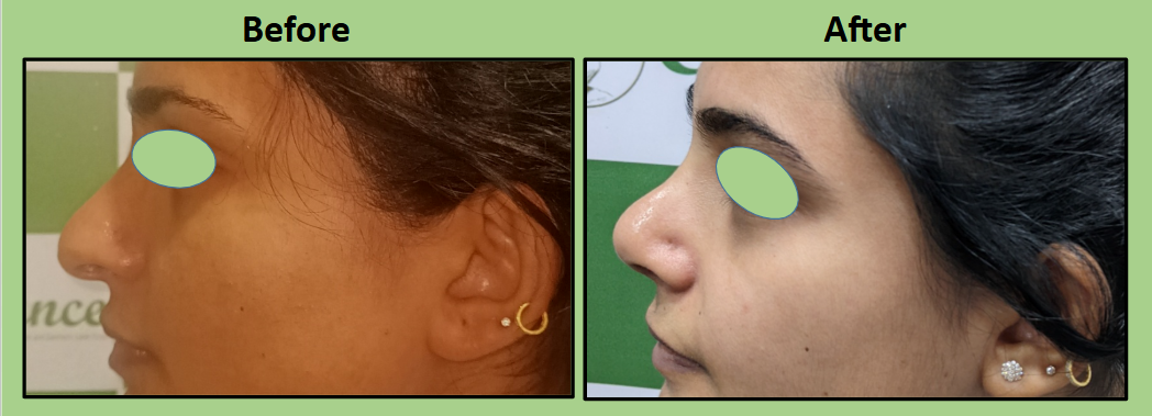 Tip elevation surgery in Surat