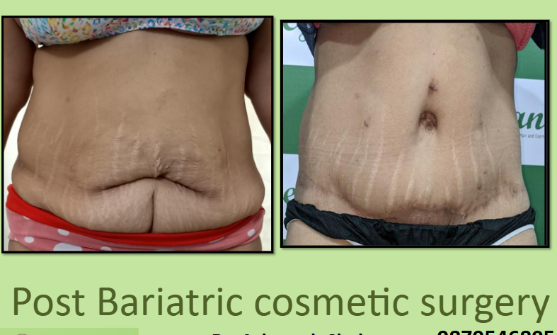 Affordable Post Bariatric cosmetic surgery near me
