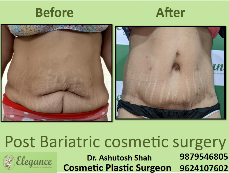Affordable Post Bariatric cosmetic surgery near me
