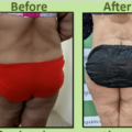 Back Contouring Surgery in Surat, Real Case of Post Weight Loss Transformation
