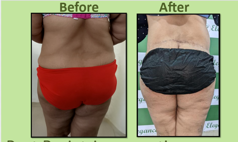 Back Contouring Surgery in Surat